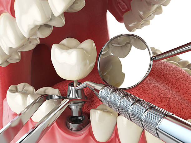 Best Emergency Treatment for Dental Infections or Abscesses in Rolla, MO